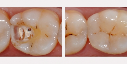 Composite dentaire - Clinique Dentaire Elysées Ponthieu - Dentiste Paris 8