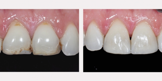Composite dentaire antérieur - Clinique Dentaire Elysées Ponthieu - Dentiste Paris 8