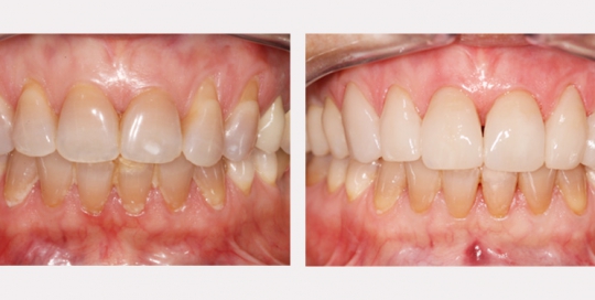 Facettes dentaires - Clinique dentaire ST-ÉTIENNE