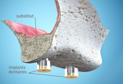 Sinus Lift - Clinique Dentaire Elysées Ponthieu - Dentiste Paris 8