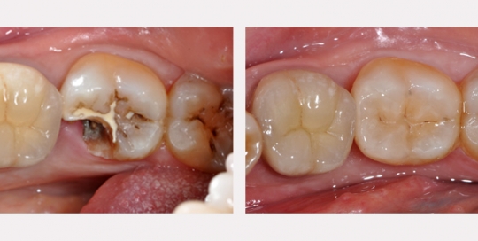 Inlay - Clinique Dentaire Elysées Ponthieu - Dentiste Paris 8