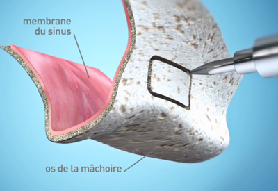 Sinus lift - Clinique Dentaire Elysées Ponthieu - Dentiste Paris 8