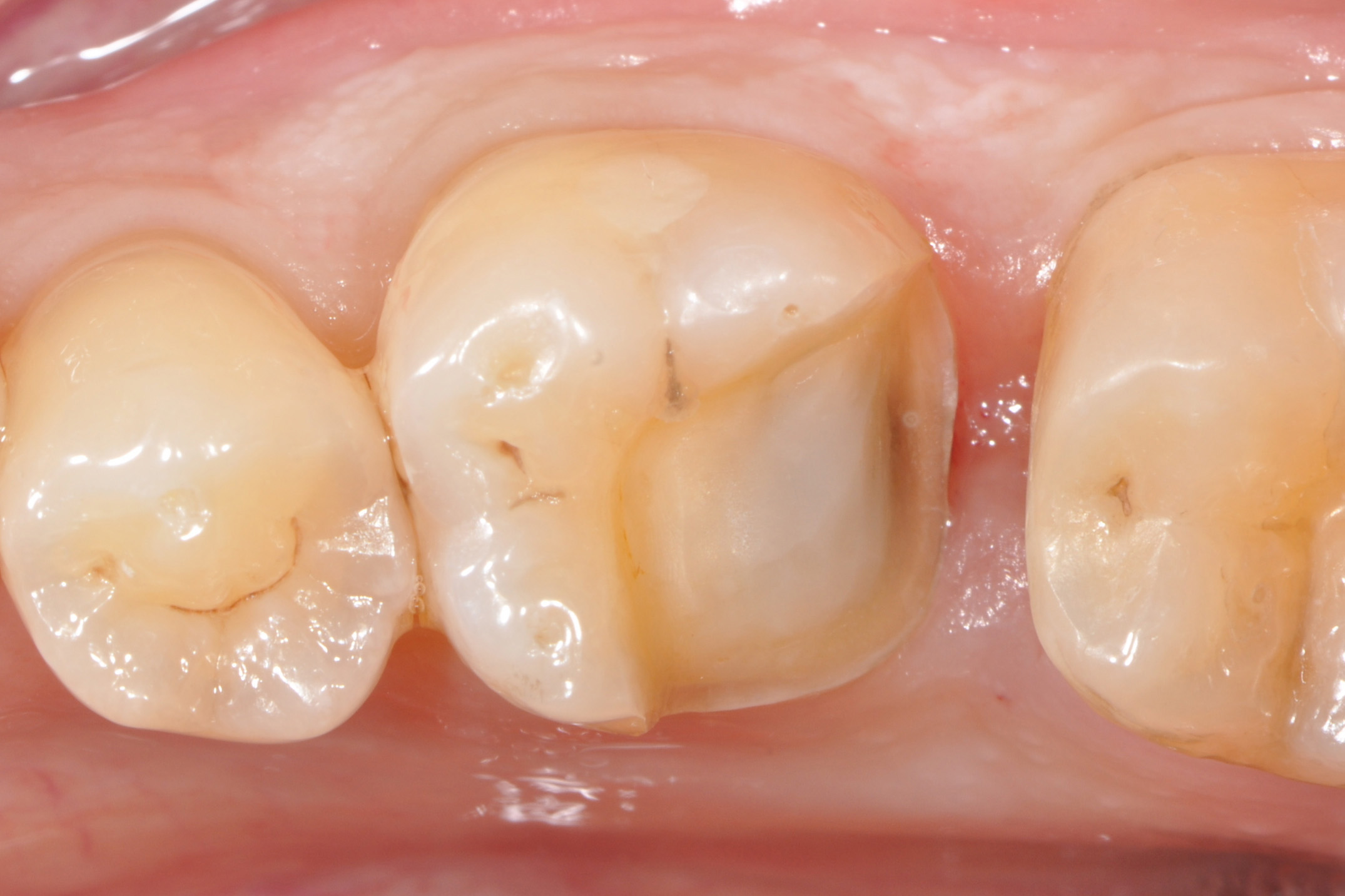 Onlay - Clinique Dentaire Elysées Ponthieu - Dentiste Paris 8