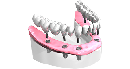 Bridge sur implant - Clinique Dentaire Elysées Ponthieu - Dentiste Paris 8