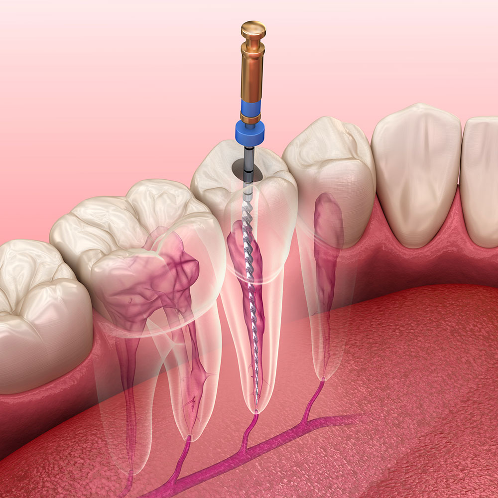 Endodontie - Clinique Dentaire Elysées Ponthieu - Dentiste Paris 8