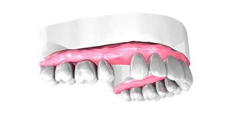 Examen pré-implantaire - Clinique Dentaire Elysées Ponthieu - Dentiste Paris 8