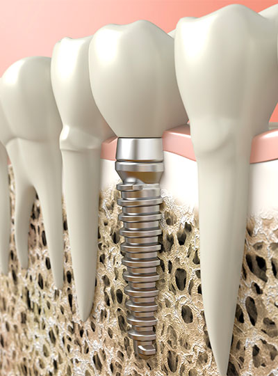 Implants dentaires - Clinique Dentaire Elysées Ponthieu - Dentiste Paris 8