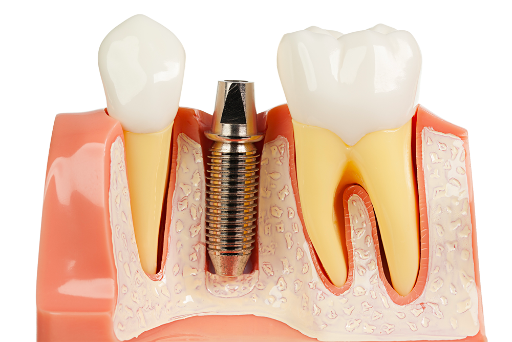 Inlay core - Clinique Dentaire Elysées Ponthieu - Dentiste Paris 8