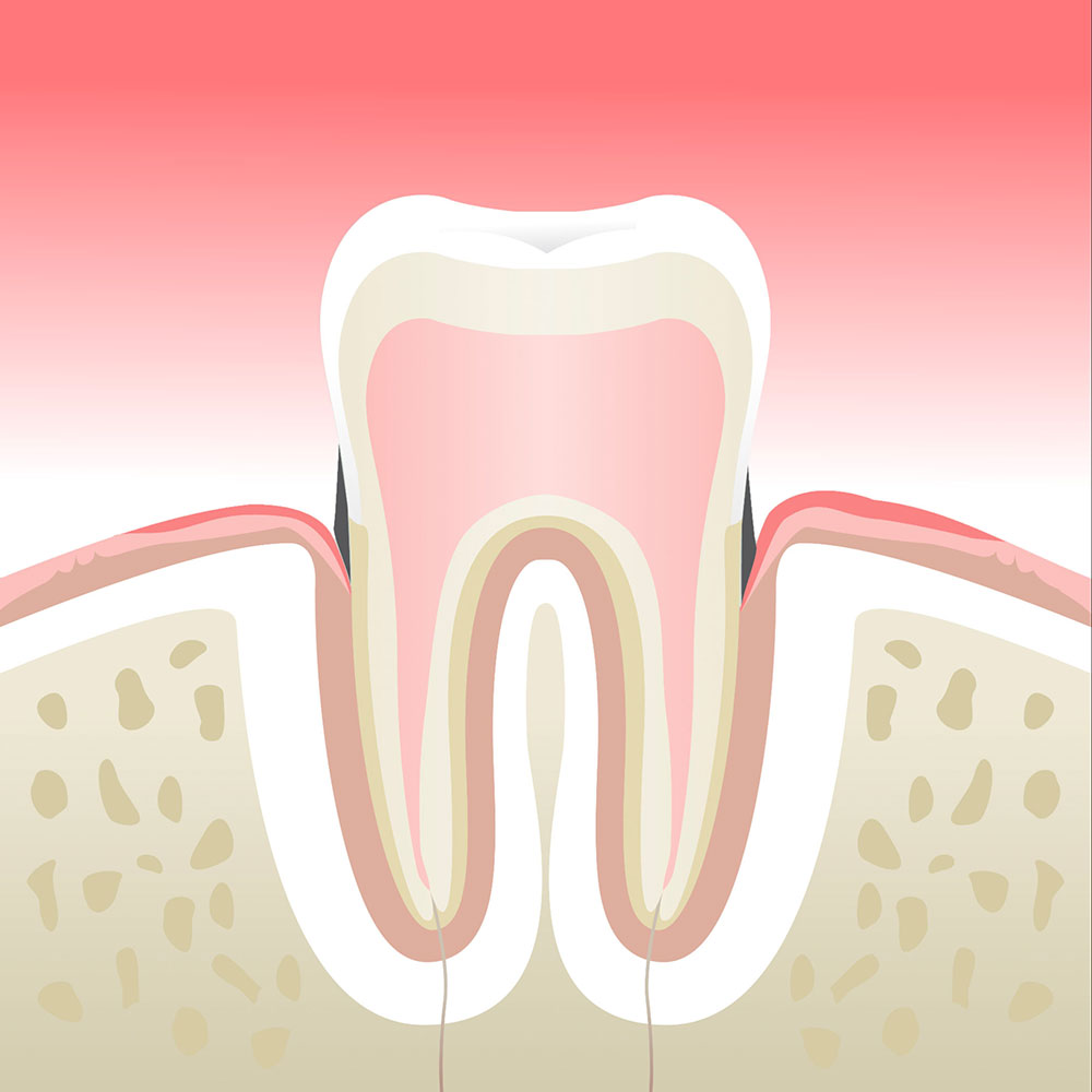 Parodontite - Clinique Dentaire Elysées Ponthieu - Dentiste Paris 8