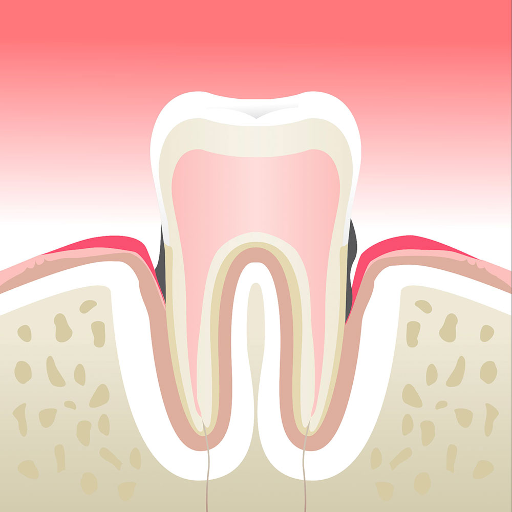 Parodontite - Clinique Dentaire Elysées Ponthieu - Dentiste Paris 8