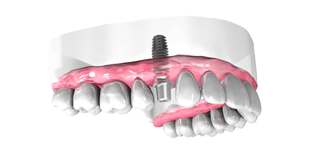 Mise en place implant dentaire - Clinique Dentaire Elysées Ponthieu - Dentiste Paris 8