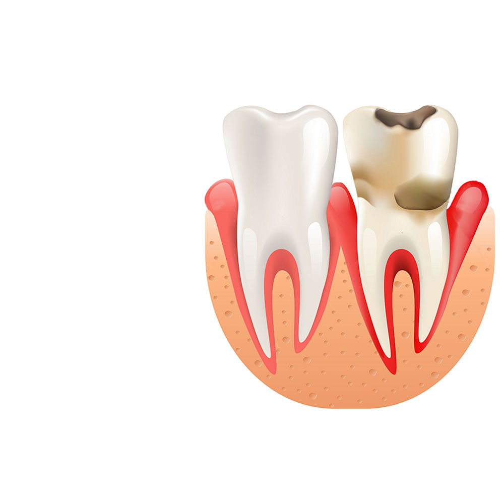 Parodontologie - Clinique Dentaire Elysées Ponthieu - Dentiste Paris 8