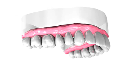 Remplacement dents manquantes - Clinique Dentaire Elysées Ponthieu - Dentiste Paris 8