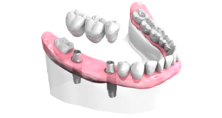 Bridge sur implants dentaires - Clinique Dentaire Elysées Ponthieu - Dentiste Paris 8