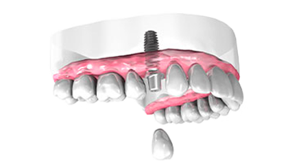 Pose couronne dentaire - Clinique Dentaire Elysées Ponthieu - Dentiste Paris 8