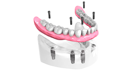 Pose implants dentaires - Clinique Dentaire Elysées Ponthieu - Dentiste Paris 8