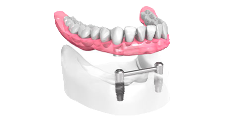 Prothèse adjointe sur barre - Clinique Dentaire Elysées Ponthieu - Dentiste Paris 8