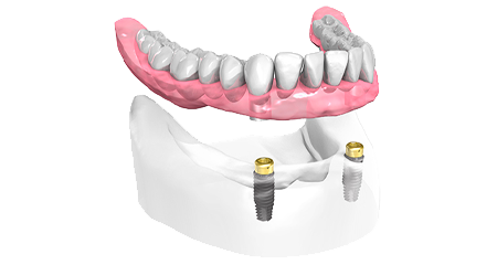 Prothèse supra implantaire - Clinique Dentaire Elysées Ponthieu - Dentiste Paris 8