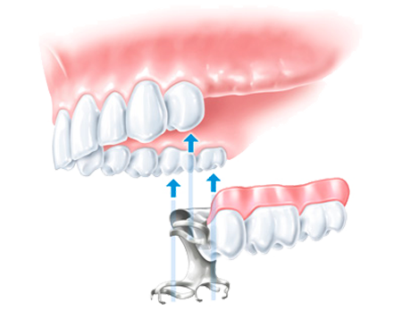 Prothèse dentaire - Clinique Dentaire Elysées Ponthieu - Dentiste Paris 8