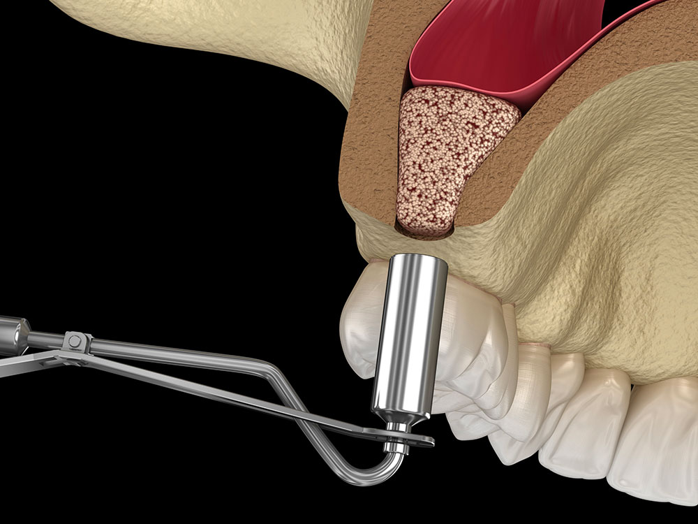 Sinus lift - Clinique Dentaire Elysées Ponthieu - Dentiste Paris 8