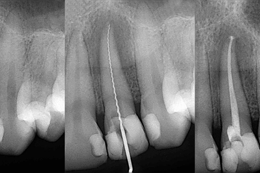 Endodontie - Clinique Dentaire Elysées Ponthieu - Dentiste Paris 8