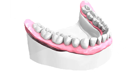 Remplacer plusieurs dents - Clinique Dentaire Elysées Ponthieu - Dentiste Paris 8